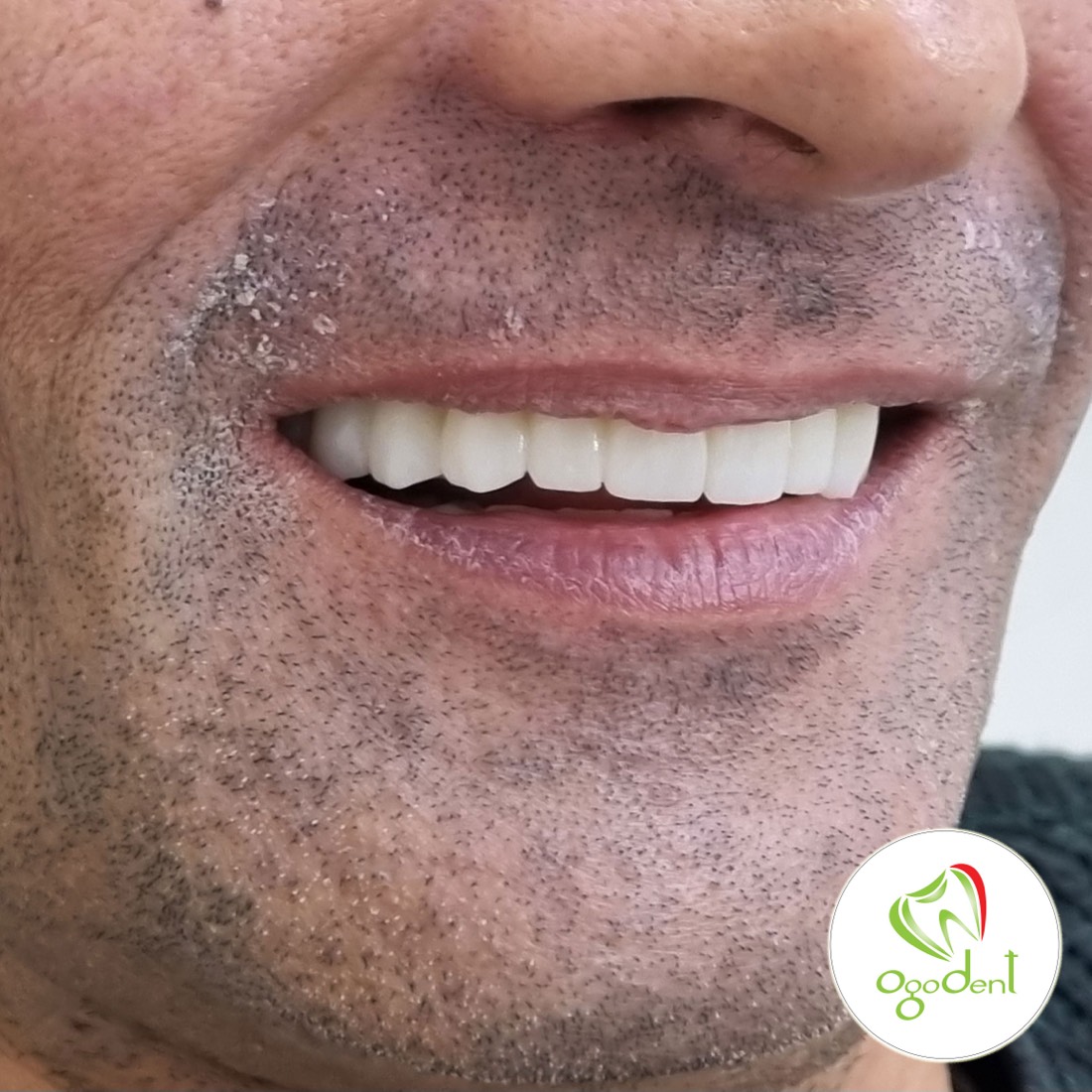Zâmbet final după reabilitarea orală completă la Ogodent